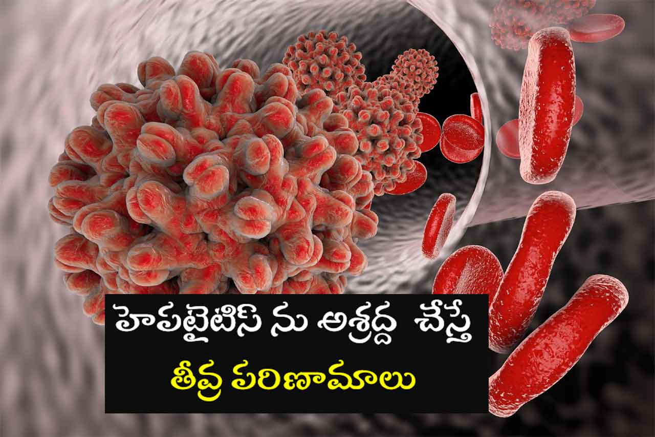 World Hepatitis Day: హెపటైటిస్‌ తో జాగ్రత్త .. లక్షణాలు.. నివారణ