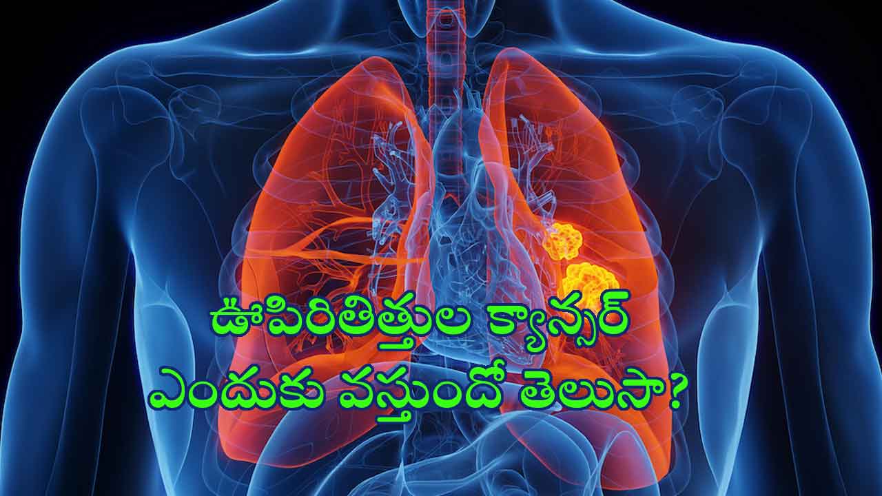 World Lung Cancer Day: ఊపిరితిత్తుల క్యాన్సర్‌ లక్షణాలు.. కారణాలు.. నివారణ